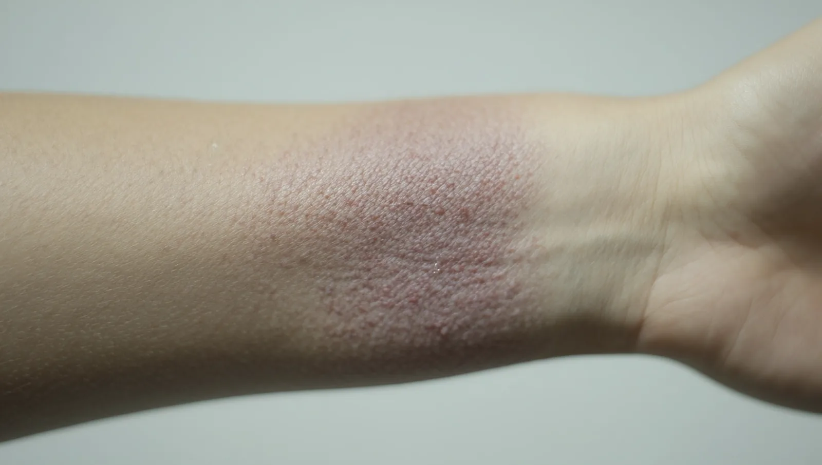 A close-up of a forearm with a distinct patch of dry, inflamed, roughened skin, the kind of area a clinician grades for redness and thickening.