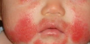 Eczema on Face - A few tips on how to reduce it