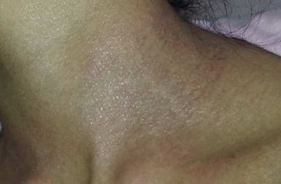 3 Tips on Preventing Eczema Facial Flare-ups