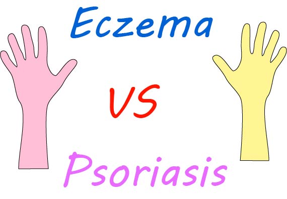 Eczema and Psoriasis - A Big Difference?